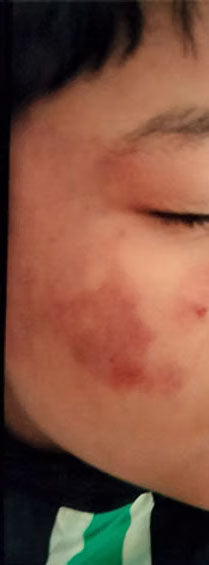 After - Birth mark reduction after 6 days topical use o...