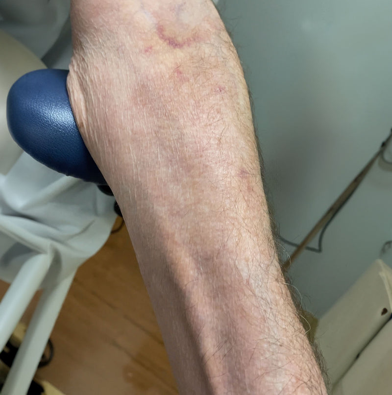 After - Dr. Fredrick Scavones Wound Healing Clinic. pat...