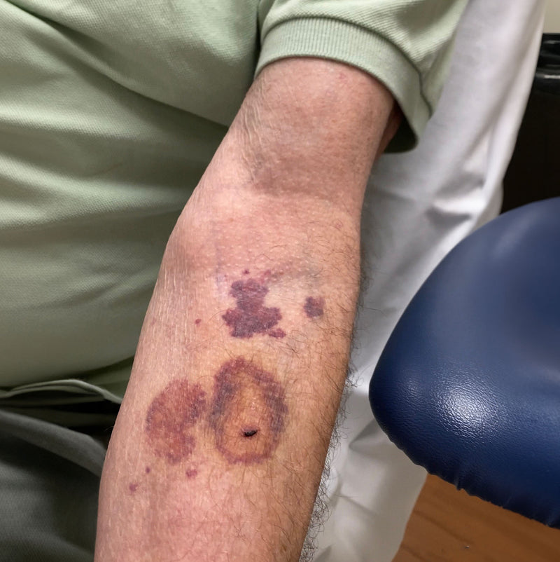 Before - Dr. Fredrick Scavones Wound Healing Clinic. pat...