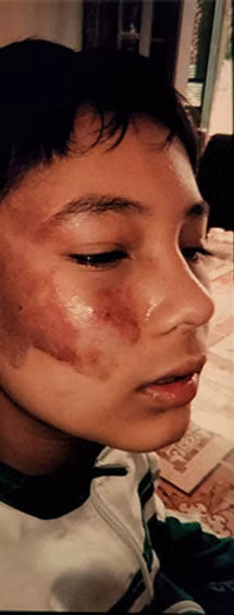 Before - Birth mark reduction after 6 days topical use o...