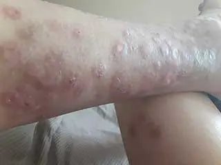 After - glyphosate exposure before and after 30 days of...