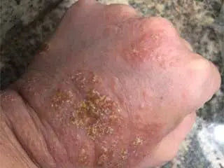 Before - Just 3 days of Greska's C60 used topically afte...