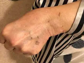 After - Just 3 days of Greska's C60 used topically afte...