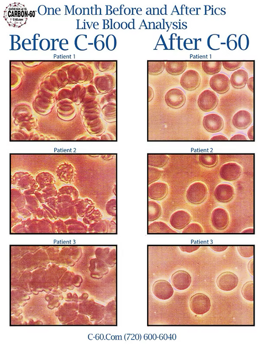 Carbon C60: Live Blood Analysis Revealed: Customer Blood Tests Before and After Pictures as Their Evidence of Greska's C60