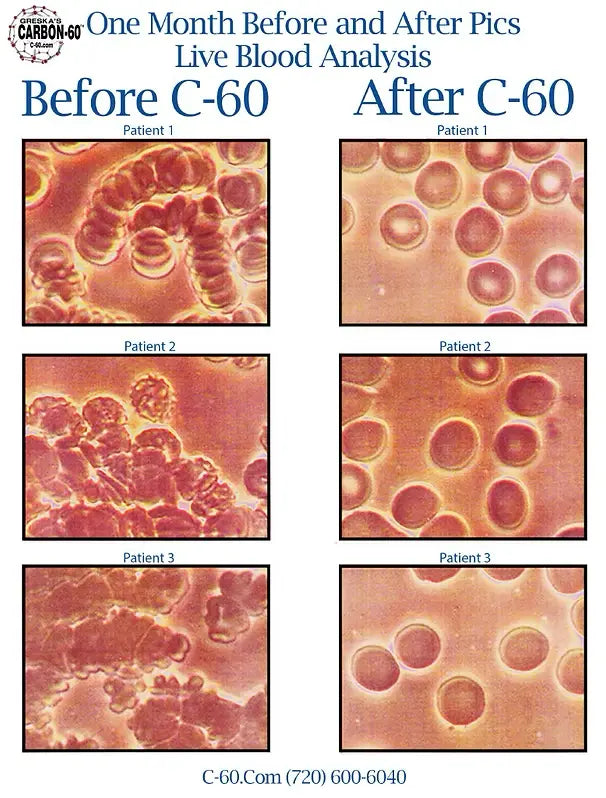 Carbon C60: Live Blood Analysis Revealed: Customer Blood Tests Before and After Pictures as Their Evidence of Greska's C60