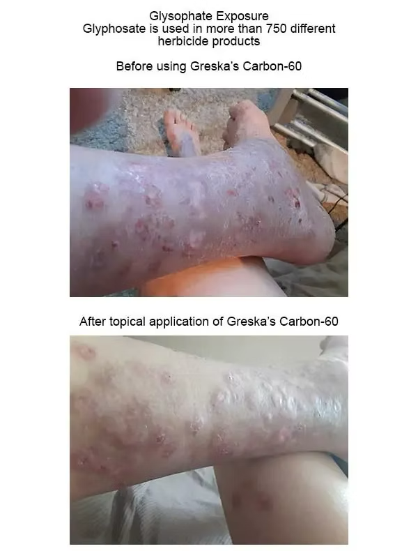 Glyphosate exposure reduced by topical Greska C60